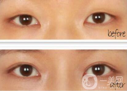 眼睛埋線后要注意什么 埋線獲得漂亮雙眼