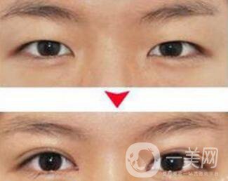 埋線雙眼皮之后禁忌有哪些？具體注意事項(xiàng)介紹