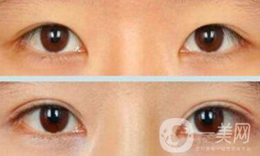 疤痕體質能割雙眼皮嗎