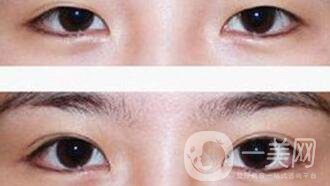 疤痕體質能割雙眼皮嗎