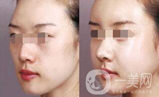 自體脂肪臉部填充可以做哪些部位