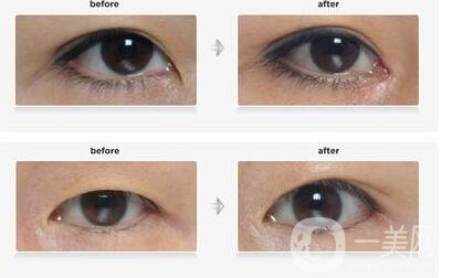 開眼角,醫(yī)院