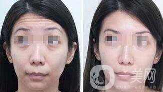 抬頭紋能消除嗎？用什么方法祛除抬頭紋