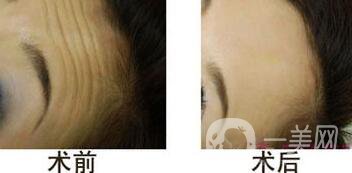 抬頭紋能消除嗎？用什么方法祛除抬頭紋