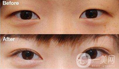 開眼角,術(shù)后護(hù)理