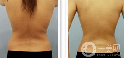 背部吸脂前后注意事項(xiàng)具體有哪些