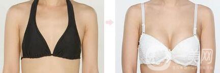 假體豐胸能保持幾年 隆胸讓你擁有身材