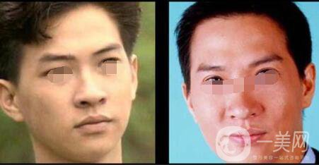 割雙眼皮術后的疤痕增生會消失嗎