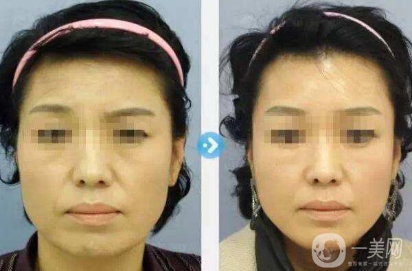 北京,面部提升,多少錢(qián)