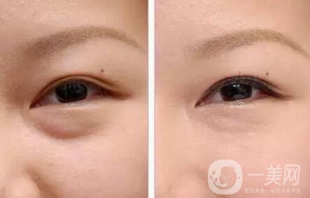 內(nèi)切祛眼袋術后護理主要有哪幾點？