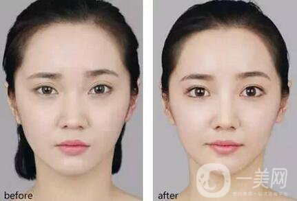 開(kāi)外眼角術(shù)前注意事項(xiàng)主要有哪幾點(diǎn)？