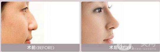 膨體隆鼻,*果怎么樣,圖