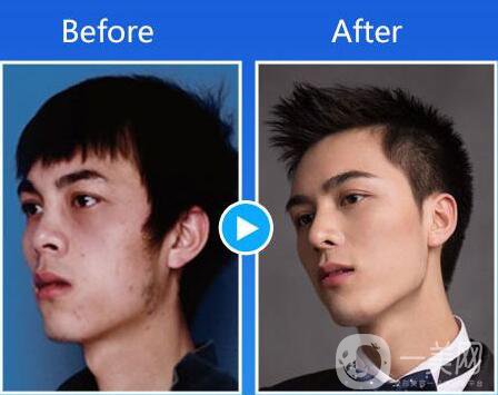 第二次隆鼻多久修復(fù)？隆鼻修復(fù)多久才可以做？