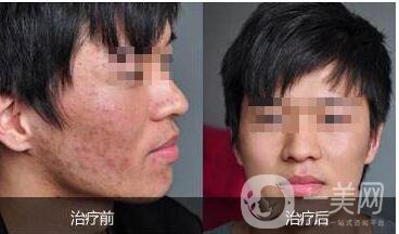 復(fù)合彩光祛痘印,注意事項(xiàng)