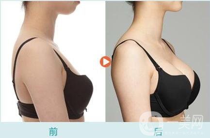 自體脂肪隆胸后多久可以恢復上班？