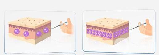自體脂肪隆胸后多久可以恢復上班？
