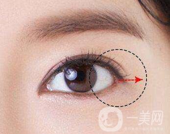 開眼角手術(shù)術(shù)前檢查什么？