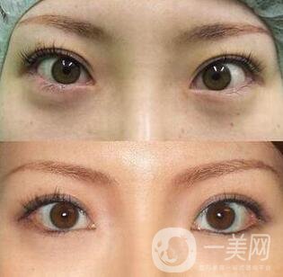 開眼角手術(shù)術(shù)前檢查什么？