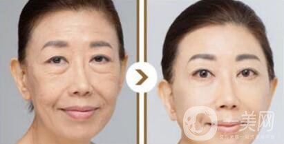 塑美極*果怎么樣？塑美極的副作用