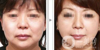 塑美極*果怎么樣？塑美極的副作用