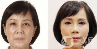 塑美極*果怎么樣？塑美極的副作用