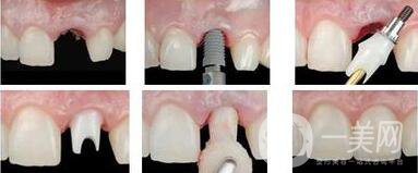 廣州做種植牙價多少錢？費用高嗎
