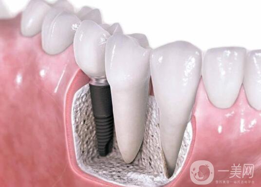 廣州做種植牙價多少錢？費用高嗎