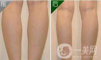 上海,抽脂瘦小腿,價(jià)格
