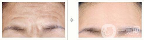 激光去抬頭紋*果怎么樣 有沒有副作用