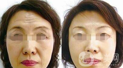 小切口拉皮除皺術(shù)能維持幾年