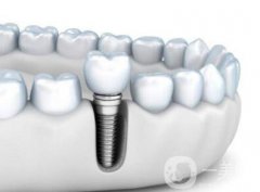 北京種植牙多少錢 種植牙過程和原理