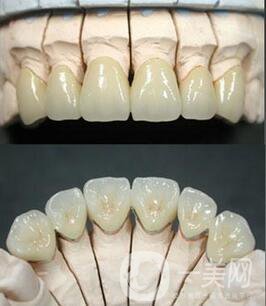 鎳鉻合金烤瓷牙是什么 *果怎么樣