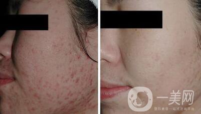 彩光祛痘原理是什么？*果如何