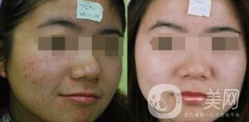 彩光祛痘原理是什么？*果如何