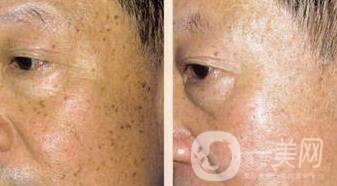 老年斑是如何產(chǎn)生的？怎么去老年斑