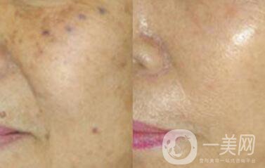 老年斑是如何產(chǎn)生的？怎么去老年斑
