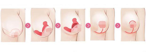 北京乳房下垂矯正手術(shù)多少錢