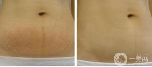 去除妊娠紋
