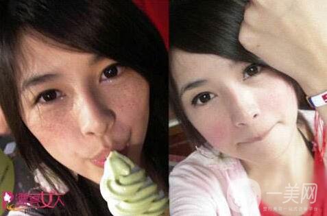 藍寶石激光祛斑好嗎