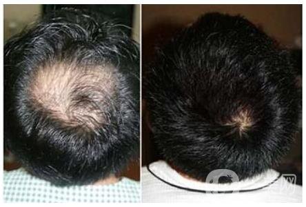 上海fut植發(fā)價(jià)格多少錢