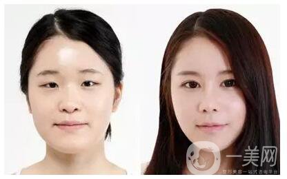 割雙眼皮有后遺癥嗎 后遺癥有哪些