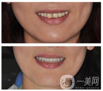 上海做貴金屬烤瓷牙多少錢