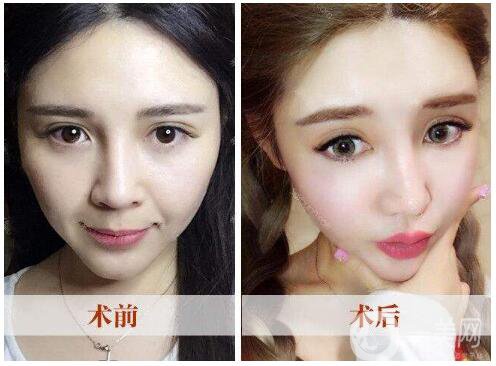 非面部提升手術(shù)怎么樣 手術(shù)多少錢