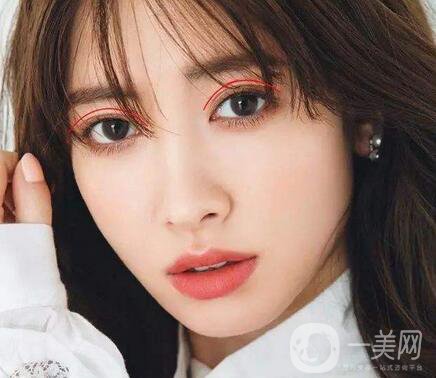 焊接雙眼皮是什么？多久能好？