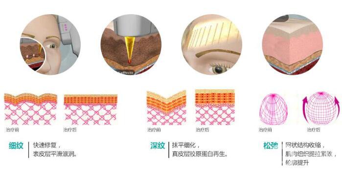 彩光嫩膚有用嗎 術(shù)后護(hù)理簡(jiǎn)析