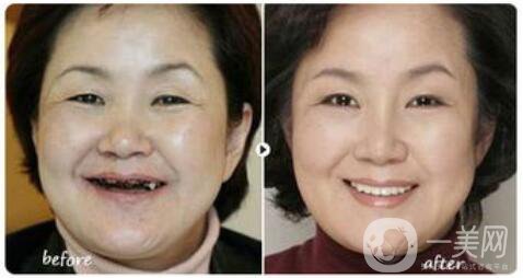 昆山種植牙價(jià)格要多少錢