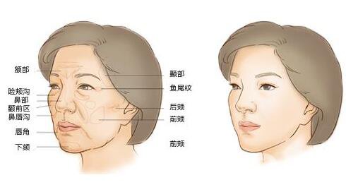 自體脂肪填充后*忌諱什么