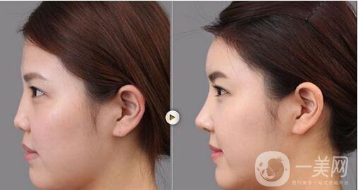 深圳,隆鼻,多少錢