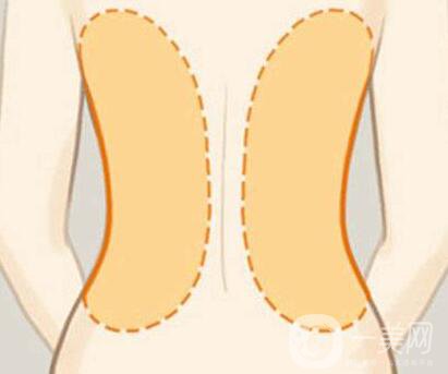 后背抽脂*果*嗎？