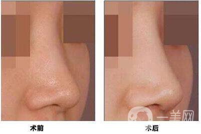 北京,鼻小柱延長,多少錢